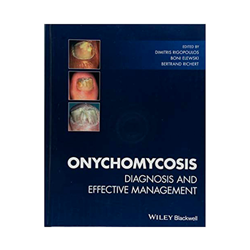 ONYCHOMYCOSIS: DIAGNOSIS AND EFFECTIVE MANAGEMENT